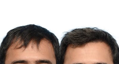 Hair Restoration Before & After Gallery - Patient 337433 - Image 1