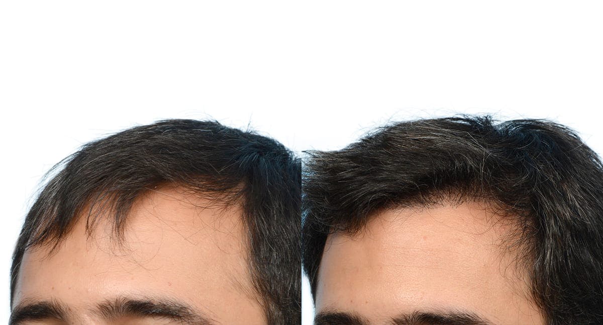 FUE Hair Transplant Before & After Gallery - Patient 206180 - Image 2