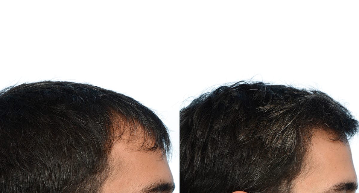 FUE Hair Transplant Before & After Gallery - Patient 206180 - Image 3