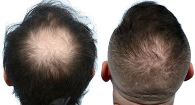 Hair Restoration Before & After Gallery - Patient 225510 - Image 1