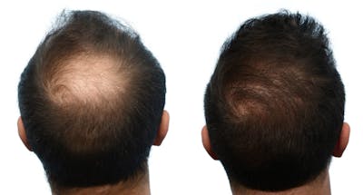Hair Restoration Before & After Gallery - Patient 169075 - Image 1