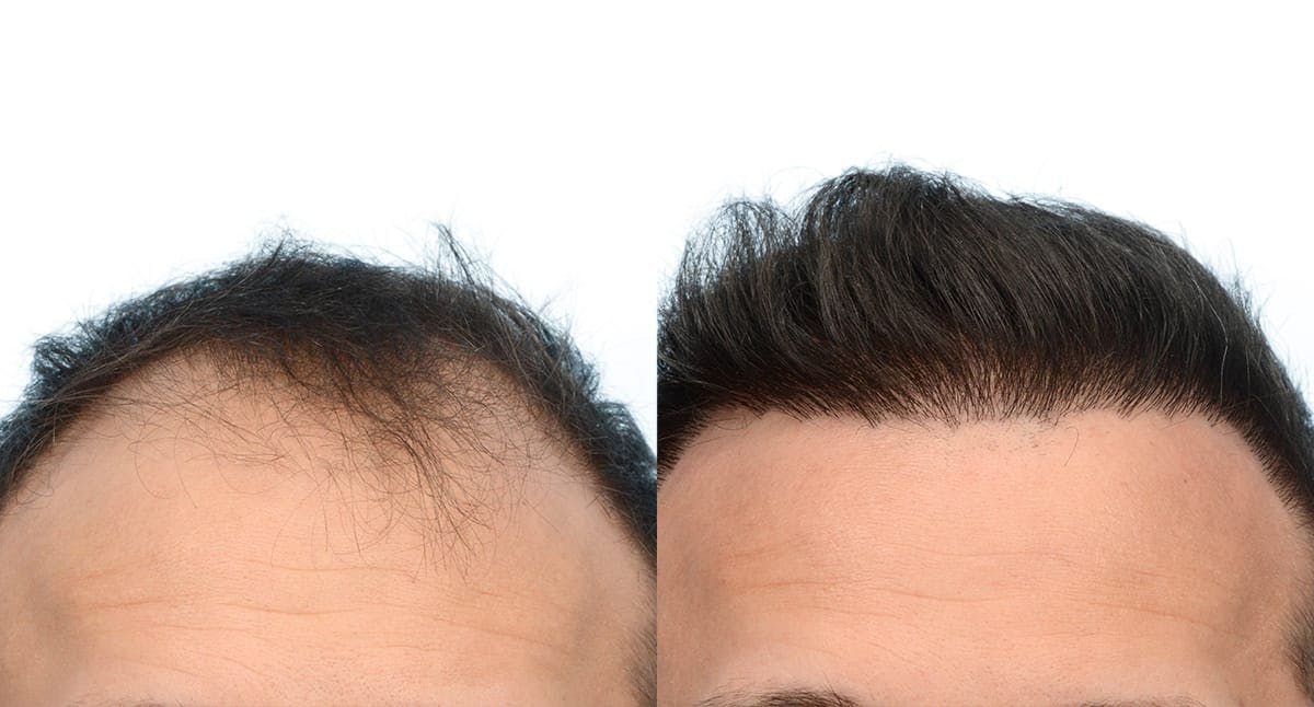 FUE Hair Transplant Before & After Gallery - Patient 293922 - Image 2