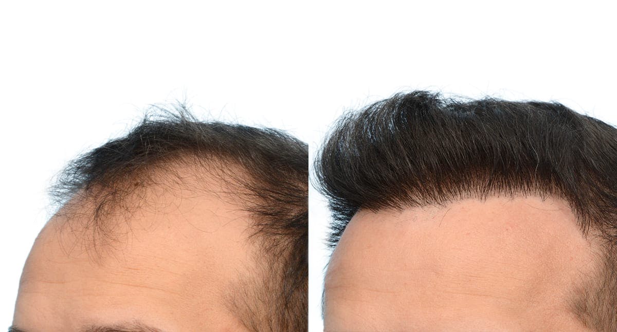 FUE Hair Transplant Before & After Gallery - Patient 293922 - Image 3