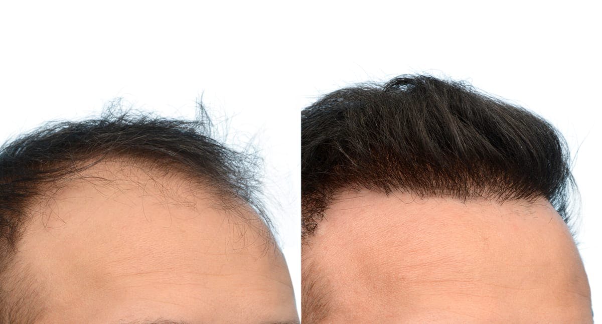 Hair Restoration Before & After Gallery - Patient 169075 - Image 4