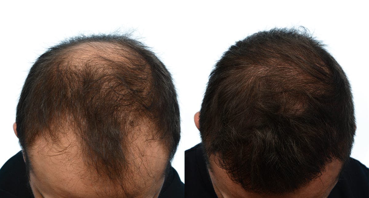 Platelet-Rich-Plasma Before & After Gallery - Patient 354627 - Image 5