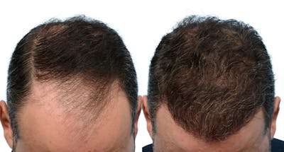 FUE Hair Transplant Before & After Gallery - Patient 428407 - Image 1