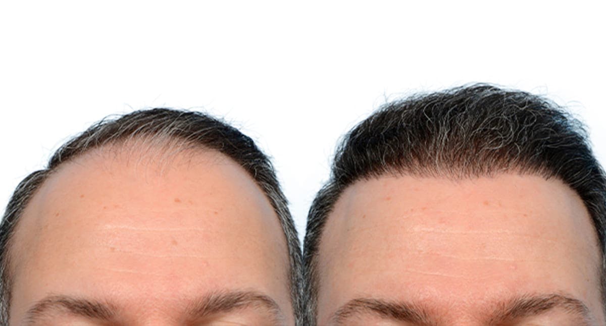 Hair Restoration Before & After Gallery - Patient 659276 - Image 2