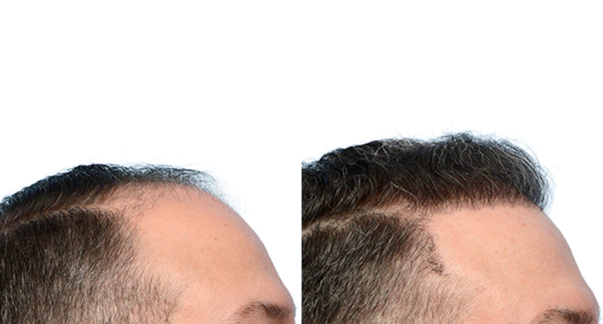 Hair Restoration Before & After Gallery - Patient 659276 - Image 3