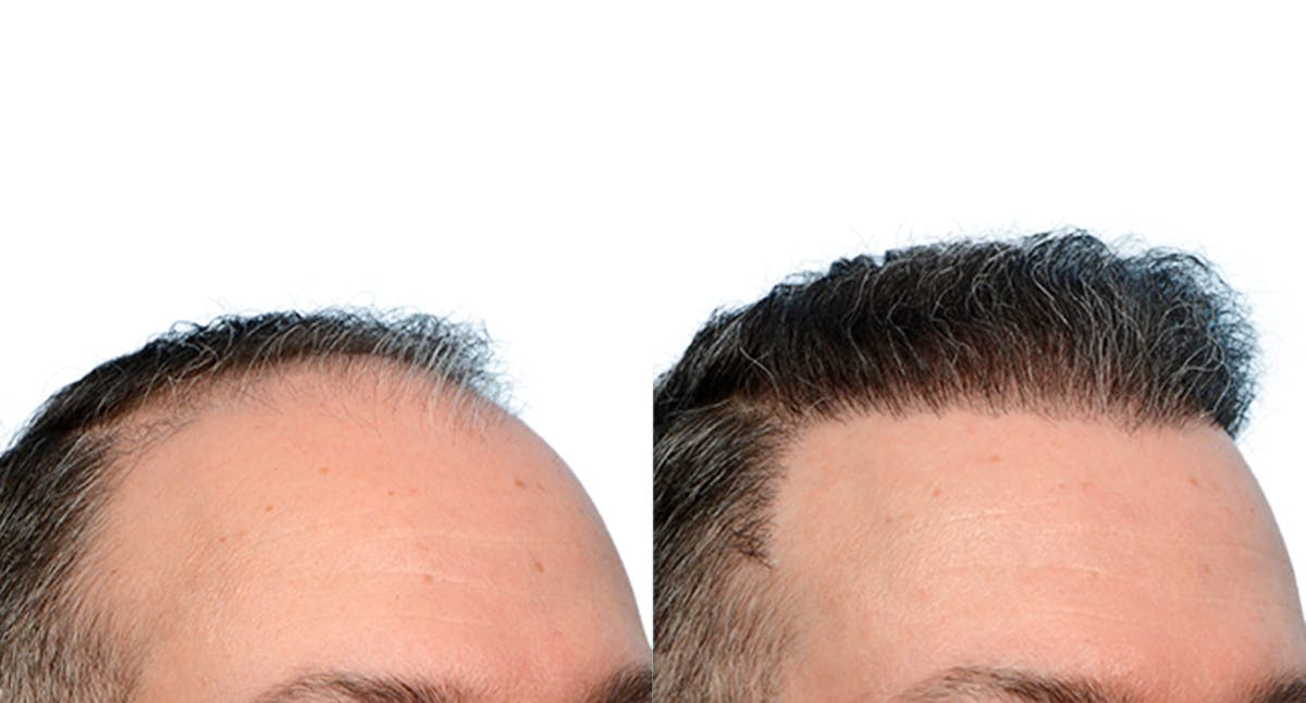 FUE Hair Transplant Before & After Gallery - Patient 428407 - Image 4