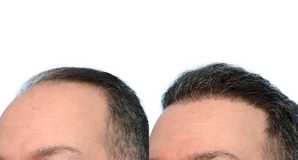 Hair Restoration Before & After Gallery - Patient 659276 - Image 5