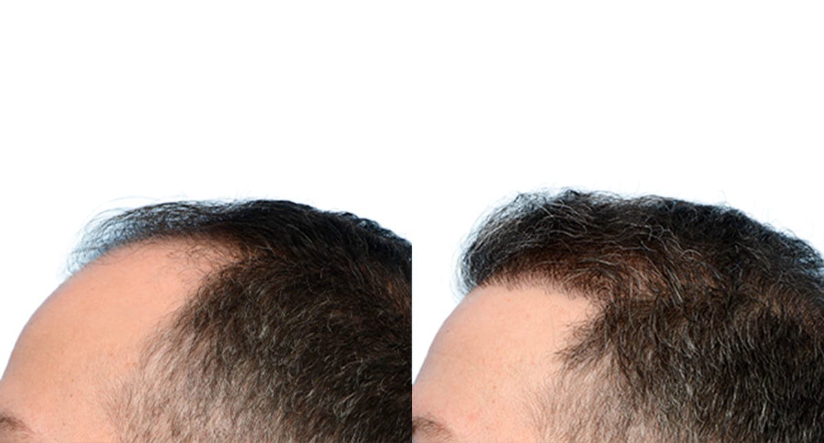 Hair Restoration Before & After Gallery - Patient 659276 - Image 6
