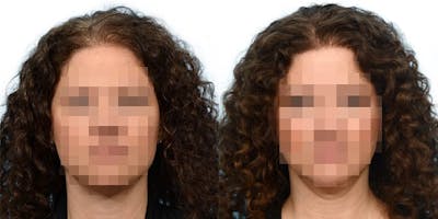 Female Hair Restoration Before & After Gallery - Patient 385285 - Image 1
