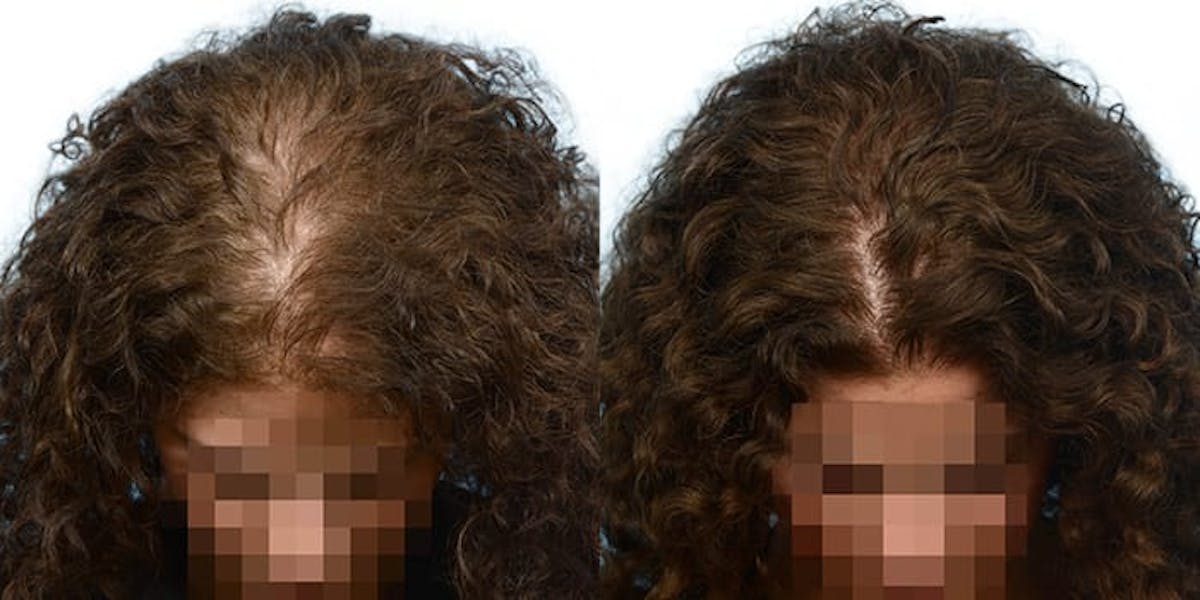 Female Hair Restoration Before & After Gallery - Patient 385285 - Image 2