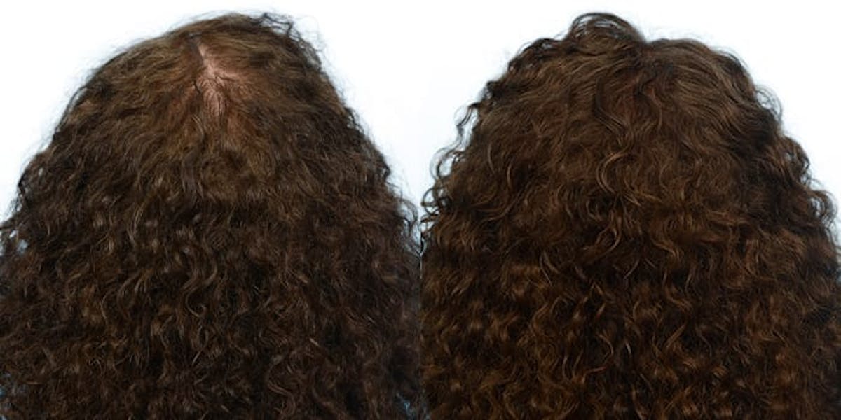 Hair Restoration Before & After Gallery - Patient 360322 - Image 3