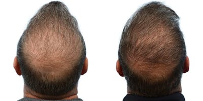 FUE Hair Transplant Before & After Gallery - Patient 256888 - Image 1