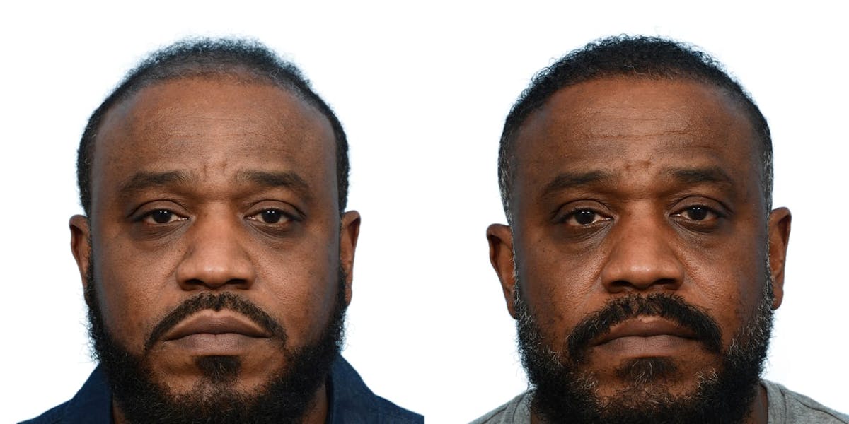 FUE Hair Transplant Before & After Gallery - Patient 103656 - Image 1
