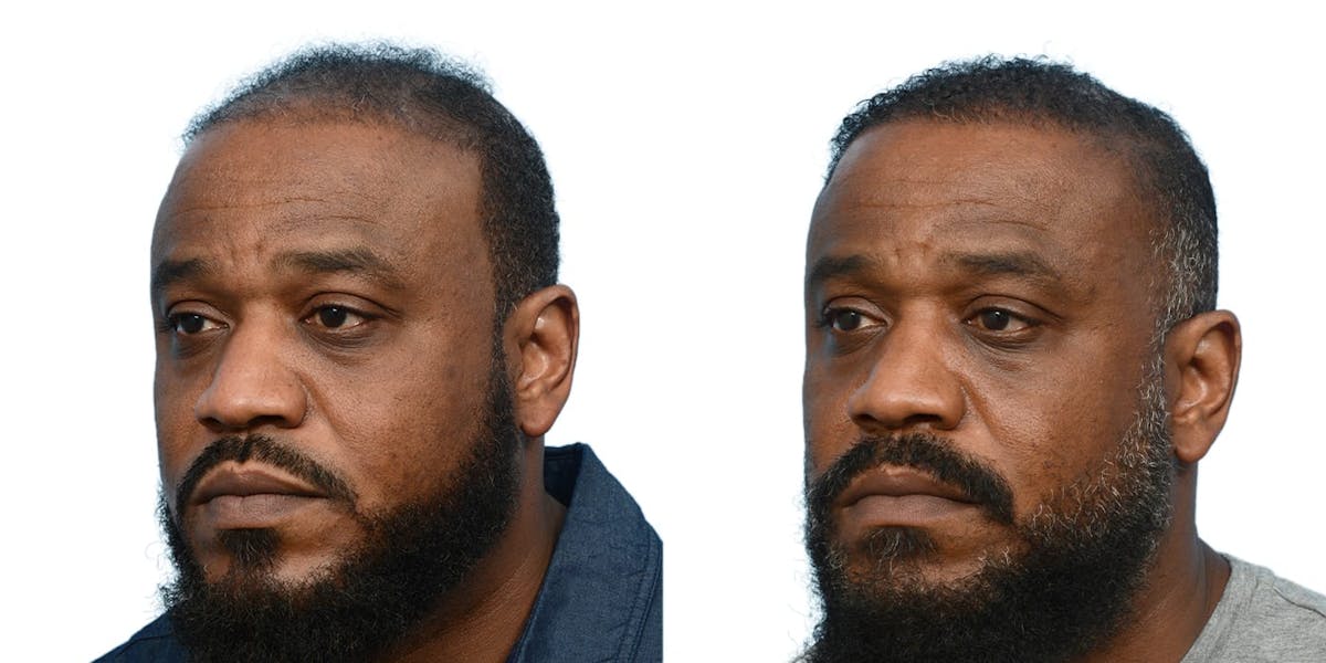 Hair Restoration Before & After Gallery - Patient 362776 - Image 2