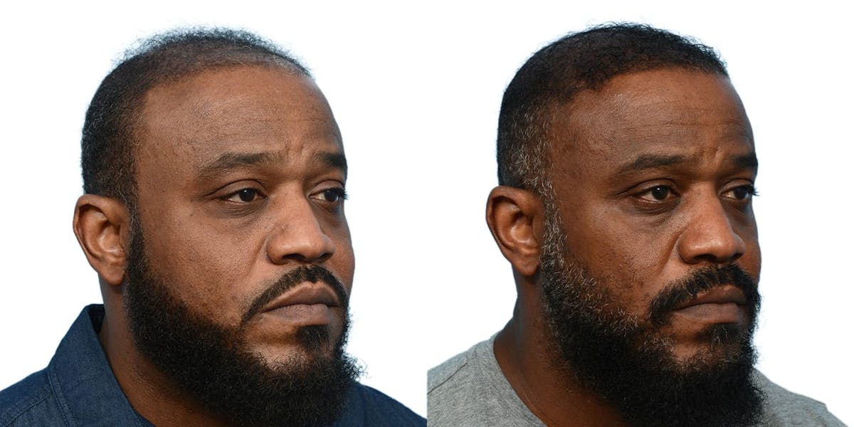 Hair Restoration Before & After Gallery - Patient 362776 - Image 3