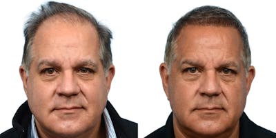 FUE Hair Transplant Before & After Gallery - Patient 308663 - Image 1