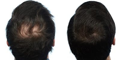 FUE Hair Transplant Before & After Gallery - Patient 351595 - Image 1
