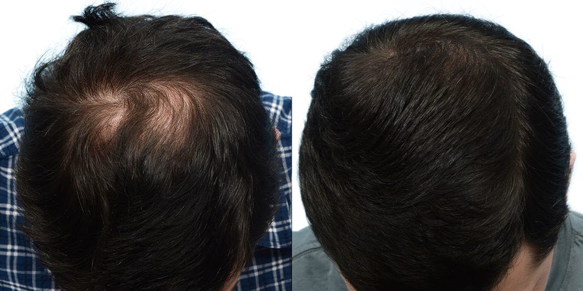 FUE Hair Transplant Before & After Gallery - Patient 351595 - Image 2