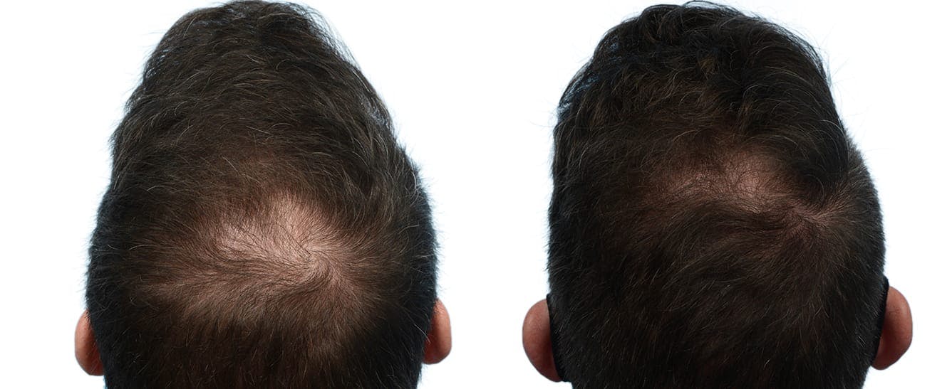 Hair Restoration  Before & After Gallery - Patient 237300 - Image 1