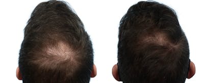 Hair Restoration Before & After Gallery - Patient 237300 - Image 1