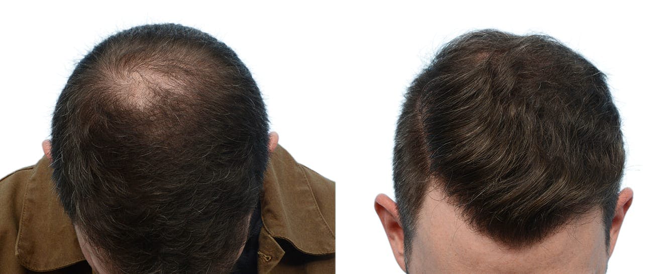 Hair Restoration  Before & After Gallery - Patient 237300 - Image 2