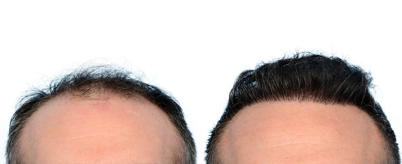 Hair Restoration  Before & After Gallery - Patient 336830 - Image 1