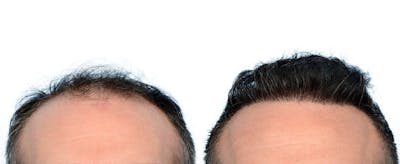 FUE Hair Transplant Before & After Gallery - Patient 294907 - Image 1