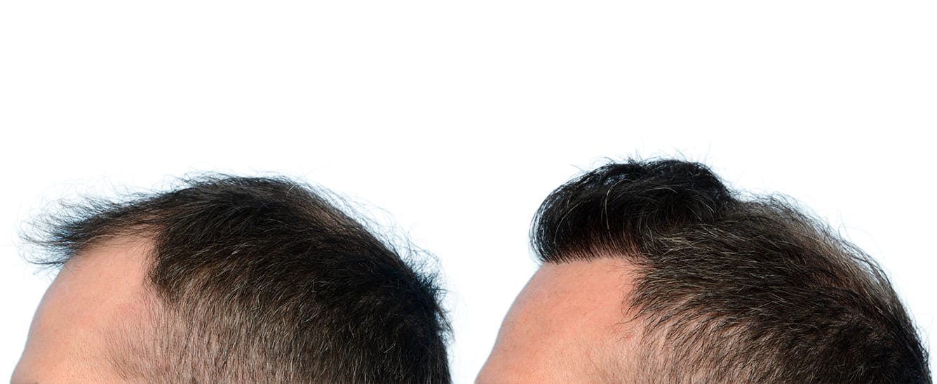 Hair Restoration  Before & After Gallery - Patient 336830 - Image 2