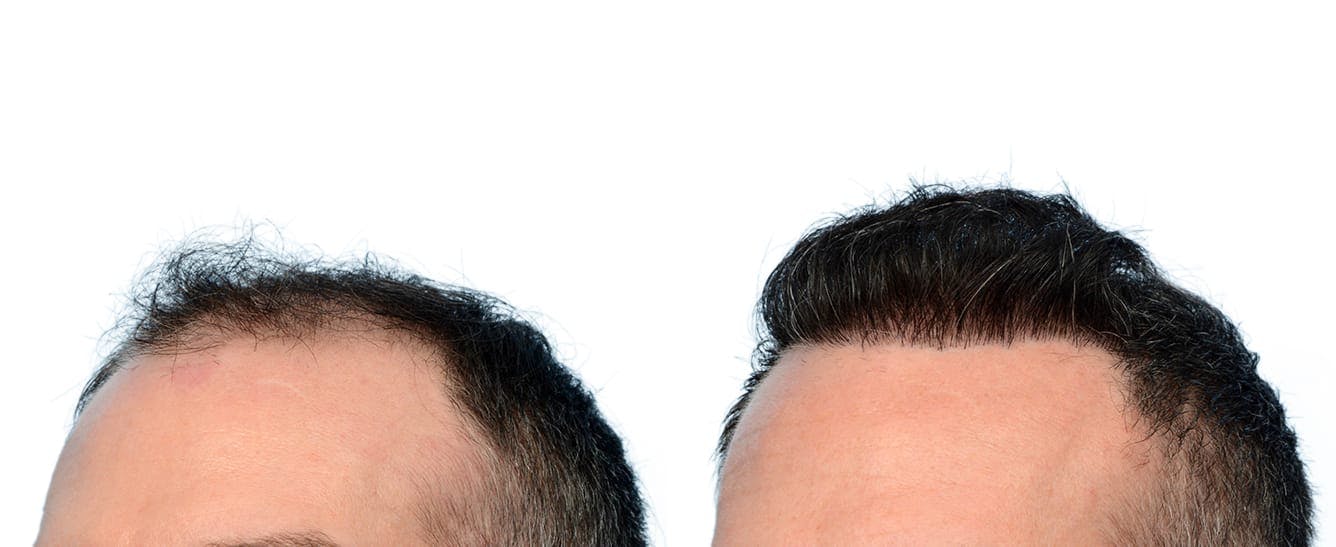 Hair Restoration  Before & After Gallery - Patient 336830 - Image 3