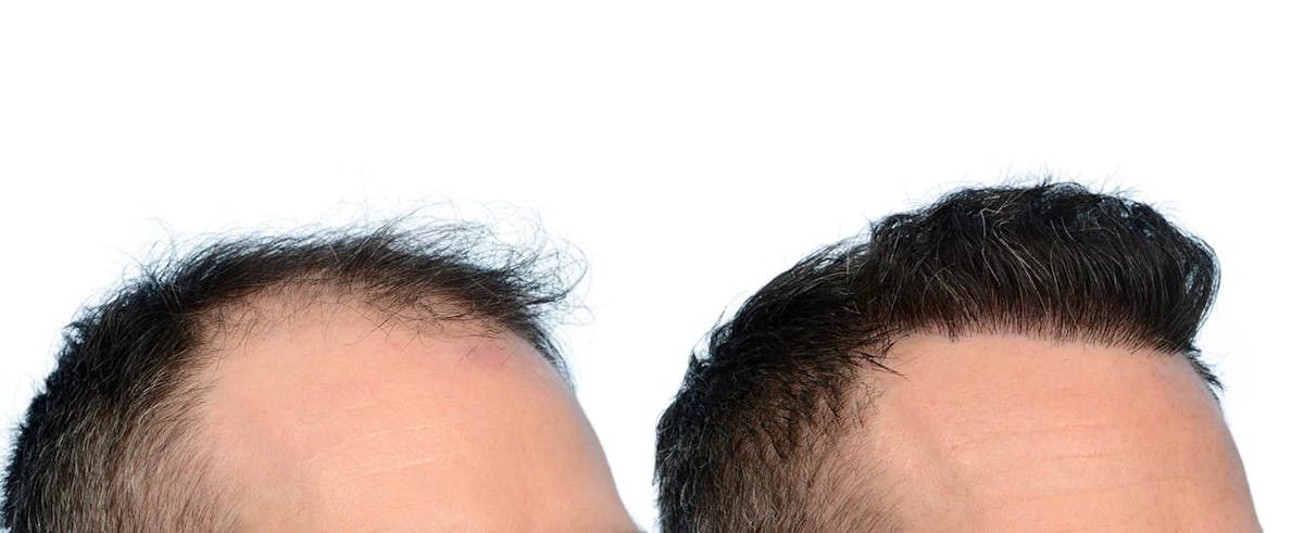 Hair Restoration Before & After Gallery - Patient 336830 - Image 4