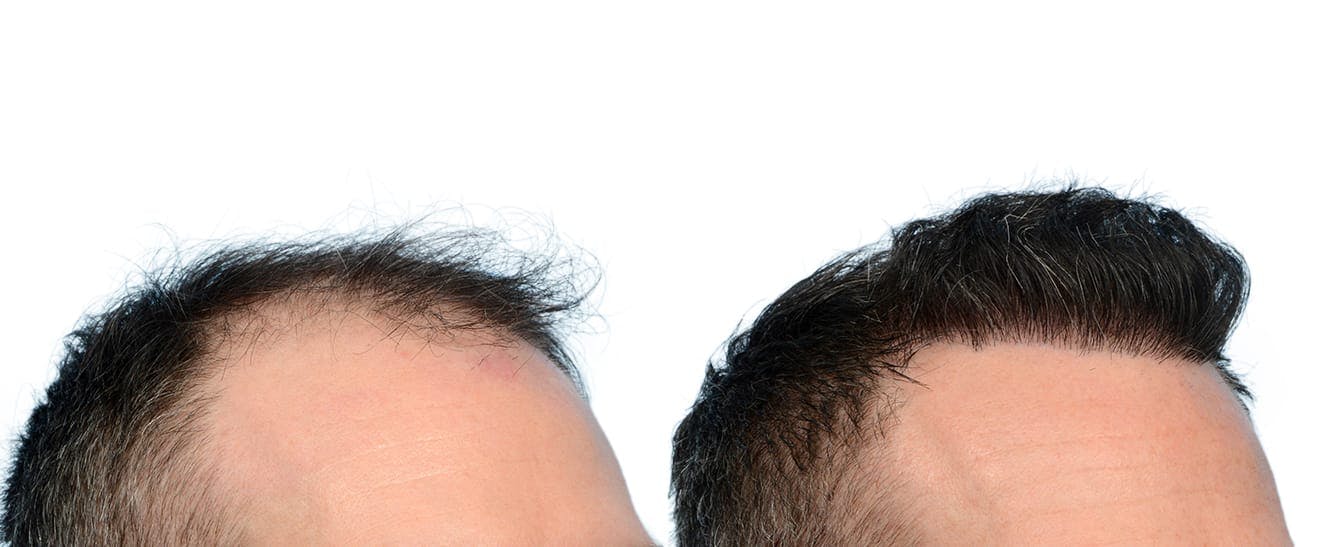 Hair Restoration  Before & After Gallery - Patient 336830 - Image 4