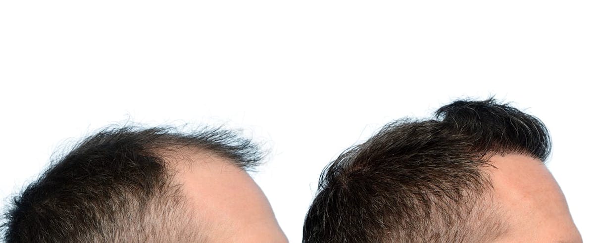 Hair Restoration Before & After Gallery - Patient 336830 - Image 5