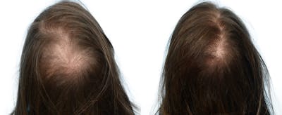 Female Hair Restoration Before & After Gallery - Patient 362362 - Image 1