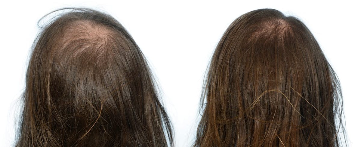 Female Hair Restoration Before & After Gallery - Patient 362362 - Image 2