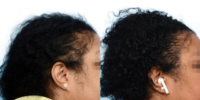 Hair Restoration Before & After Gallery - Patient 938093 - Image 1