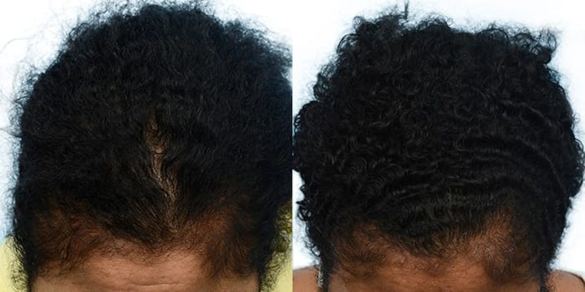 Female Hair Restoration Before & After Gallery - Patient 353194 - Image 2