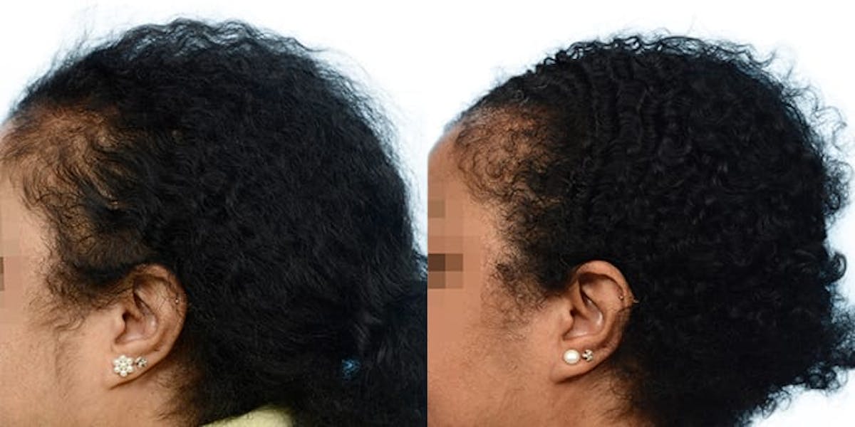 Female Hair Restoration Before & After Gallery - Patient 353194 - Image 3