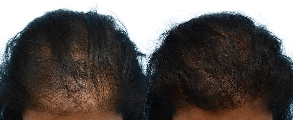 Hair Restoration Before & After Gallery - Patient 515681 - Image 1