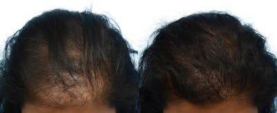 Female Hair Restoration Before & After Gallery - Patient 569680 - Image 1