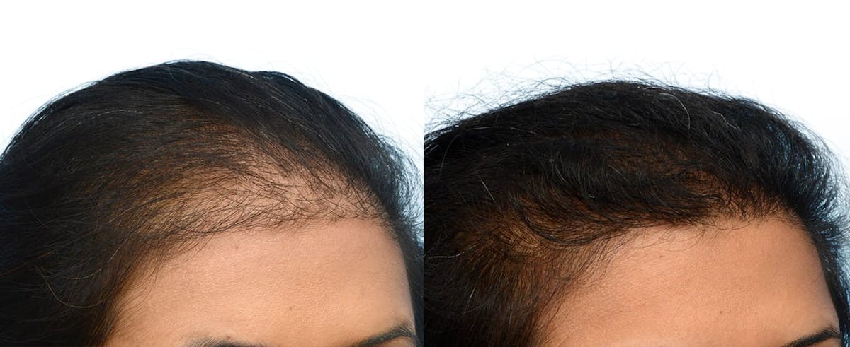 Female Hair Restoration Before & After Gallery - Patient 569680 - Image 2