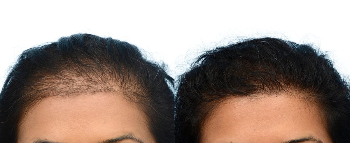 Hair Restoration Before & After Gallery - Patient 515681 - Image 3