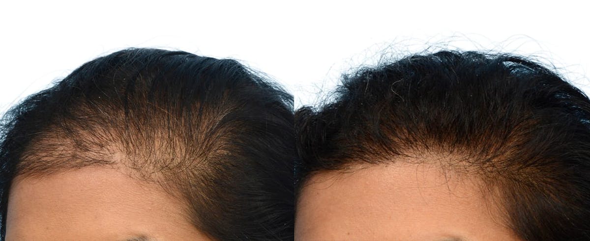Hair Restoration Before & After Gallery - Patient 515681 - Image 4
