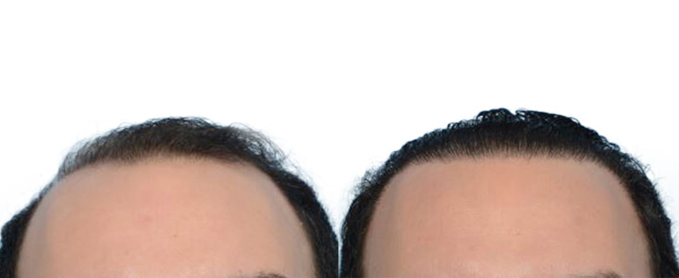 Hair Restoration  Before & After Gallery - Patient 259043 - Image 1
