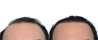 FUE Hair Transplant Before & After Gallery - Patient 393515 - Image 1