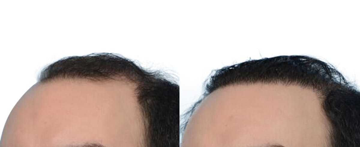 Hair Restoration Before & After Gallery - Patient 259043 - Image 2
