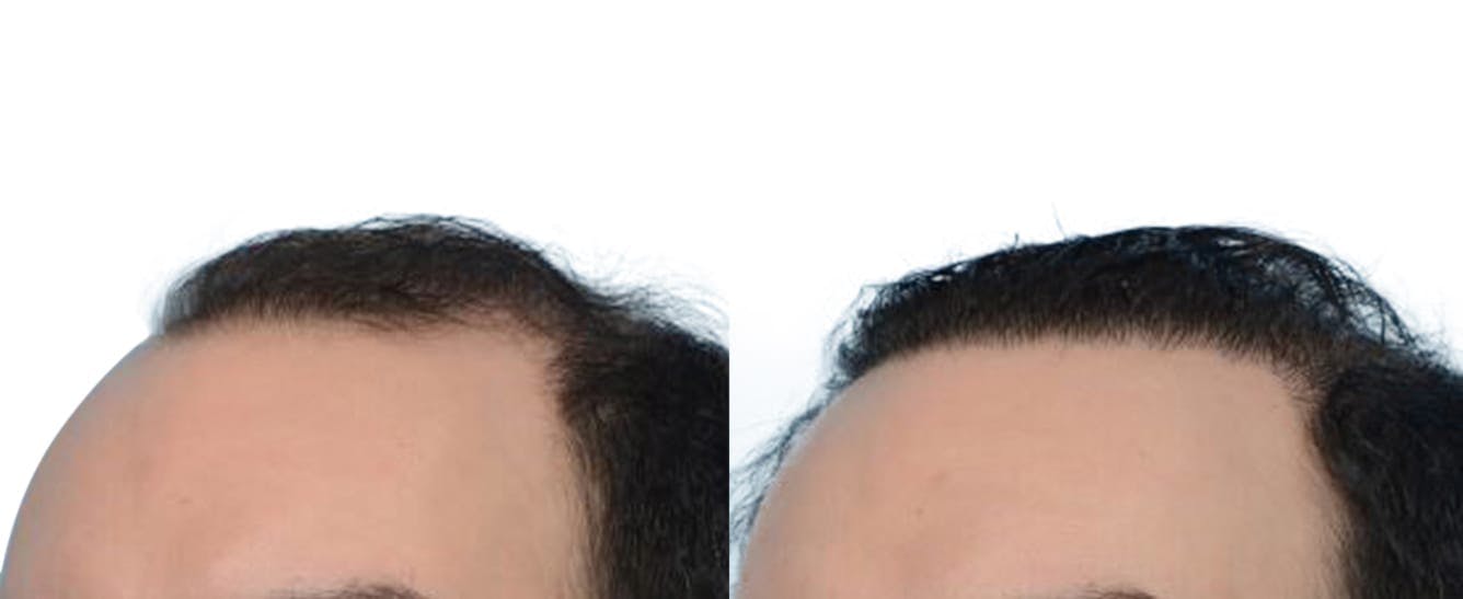 Hair Restoration  Before & After Gallery - Patient 259043 - Image 2