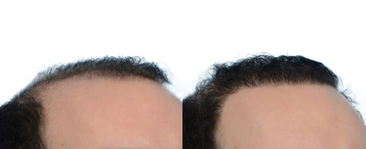 Hair Restoration Before & After Gallery - Patient 259043 - Image 3